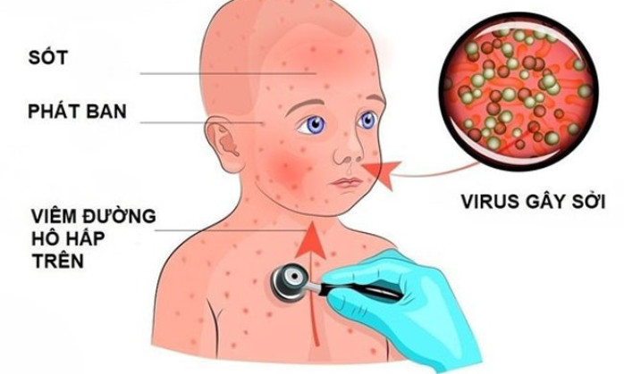 Biện pháp phòng ngừa bệnh sởi cho trẻ