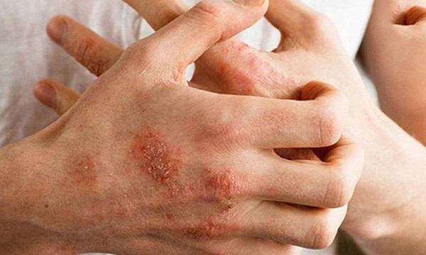 Giao mùa thận trọng với dị ứng thời tiết
