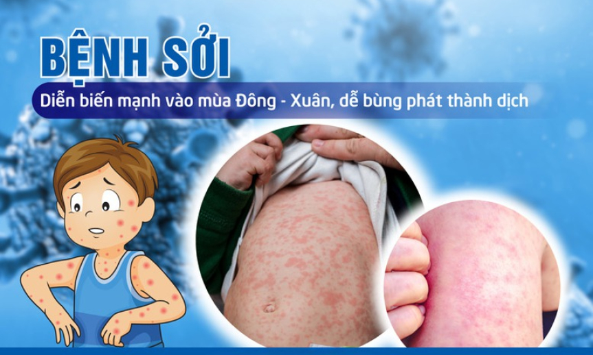 Không chủ quan với bệnh sởi có nguy cơ bùng phát