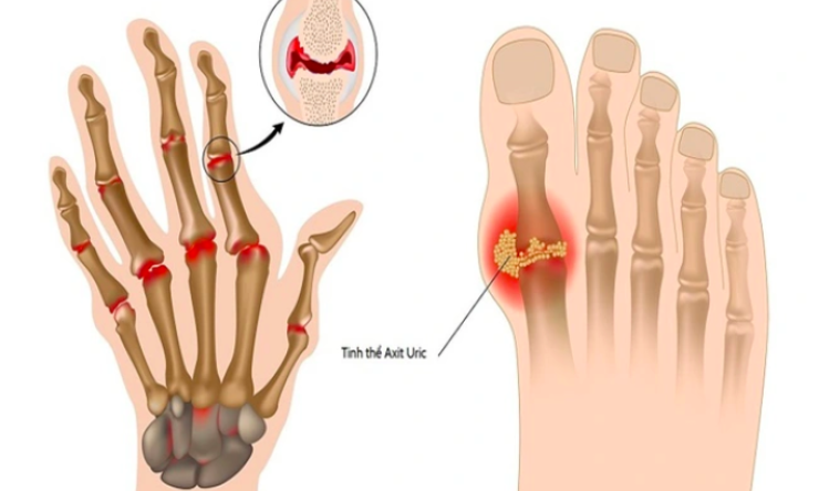 5 cách đào thải axit uric nhanh khỏi cơ thể cần biết