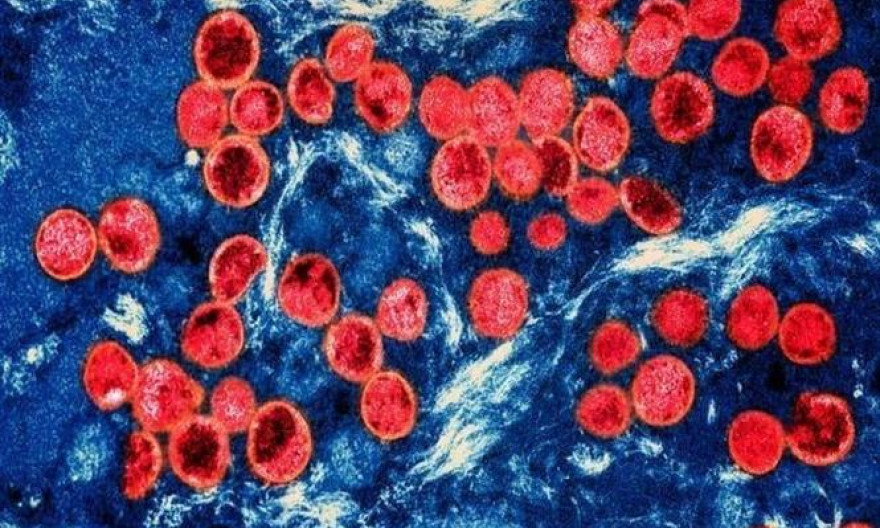 Pháp phát hiện ca nhiễm biến thể mới của virus đậu mùa khỉ