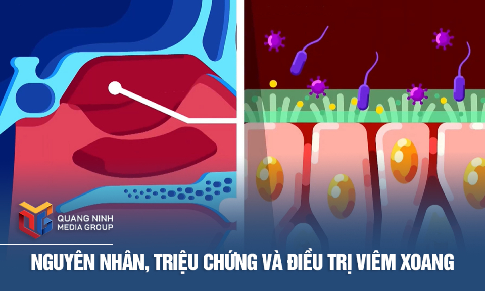 Nguyên nhân, triệu chứng và điều trị viêm xoang