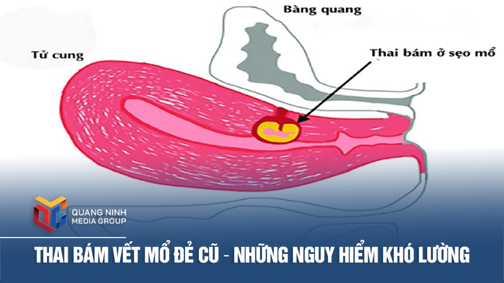 Thai bám vết mổ đẻ cũ – Những nguy hiểm khó lường