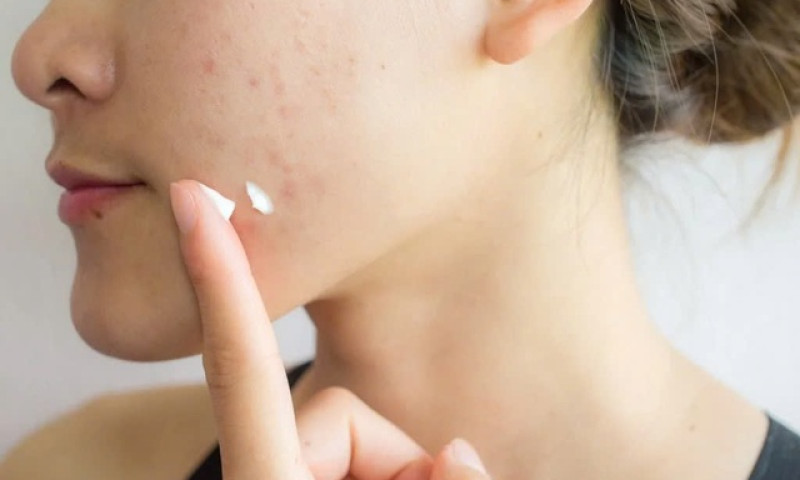 Da mụn nên trang điểm thế nào vừa che khuyết điểm vừa không gây bí da?