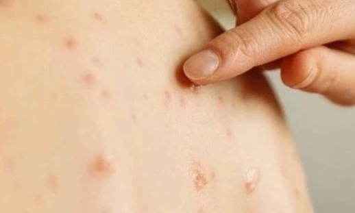 5 điều cần biết về bệnh thủy đậu