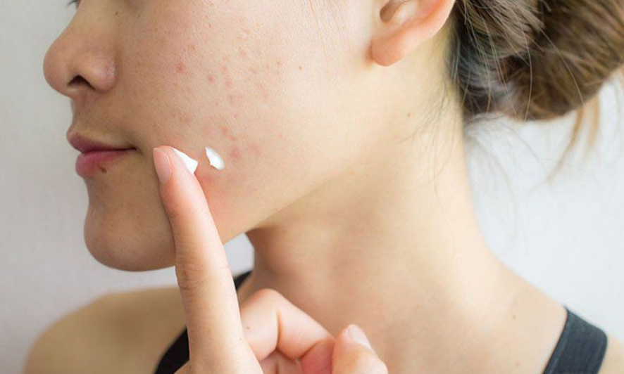 Mụn mãi không hết? Đã đến lúc bạn cần đi khám da liễu!