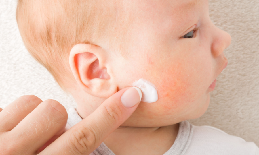 Skinoo Baby Cream - Chìa khóa cho hàng rào bảo vệ da khỏe mạnh
