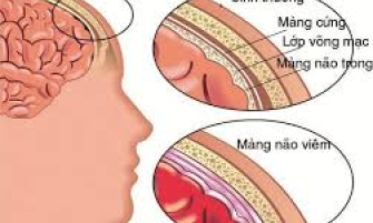 Não mô cầu: Căn bệnh có thể gây nguy kịch trong vài giờ