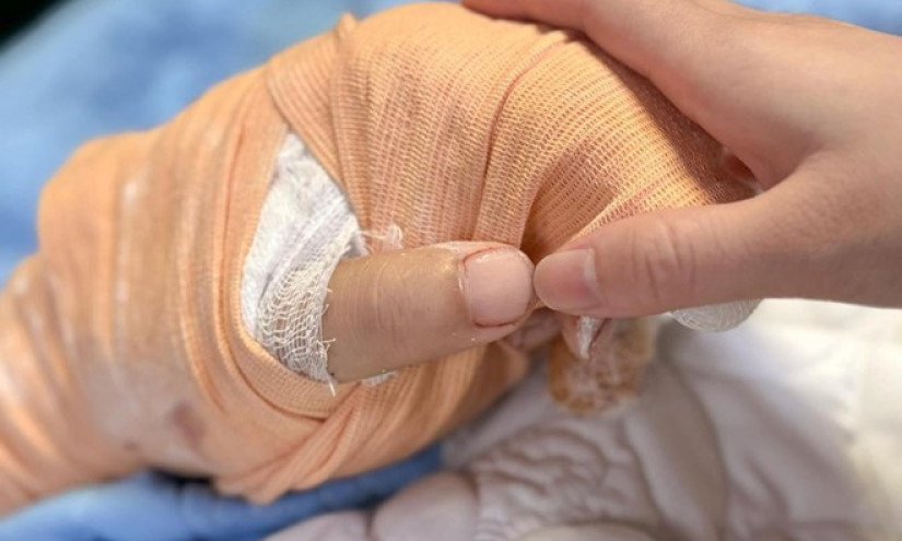 Nối lại thành công bàn tay bị chém lìa của nam TikToker có tiếng ở Thái Nguyên