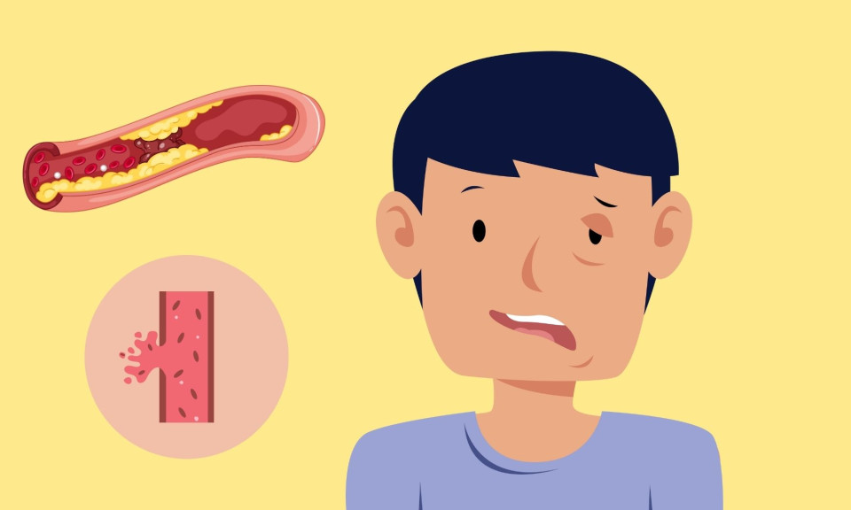 Lối sống hiện đại và sự gia tăng đột quỵ ở giới trẻ