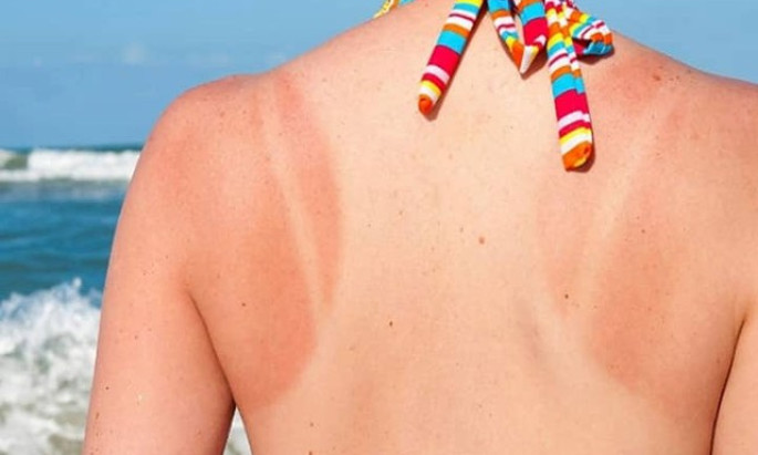 Cách phục hồi làn da sau rám nắng mùa hè