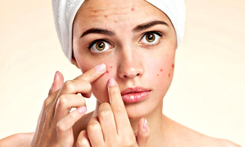 Cách xử lý mụn trứng cá, phục hồi làn da khỏe mạnh sau mụn