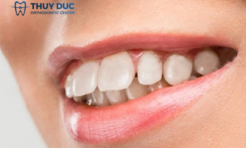 Niềng răng hô nhẹ mất bao lâu? Xem giải đáp chi tiết