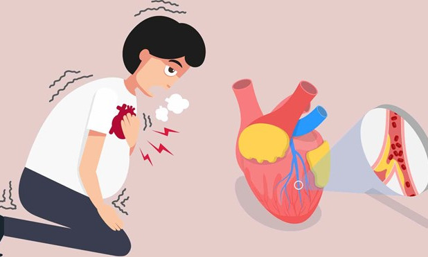 3 biểu hiện cảnh báo nhồi máu cơ tim dễ bị bỏ qua