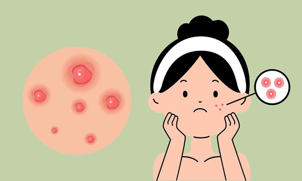 3 nguyên nhân âm thầm khiến mụn ở lì trên da