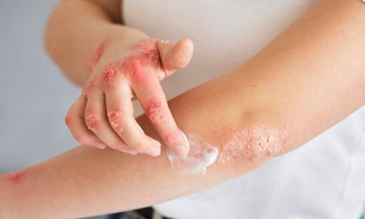 Những biện pháp tránh ngứa, dị ứng trong mùa mưa lũ